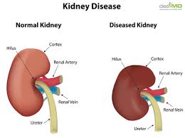 Ảnh 3 của Kidney Failture